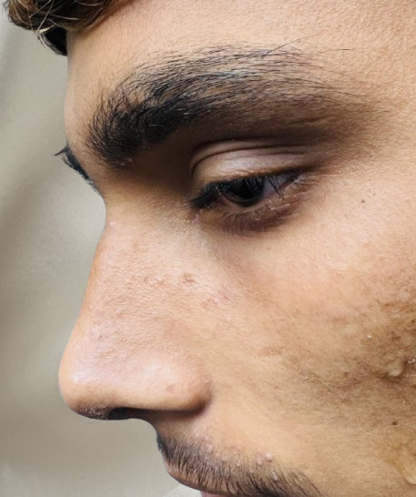 After Septorhinoplasty