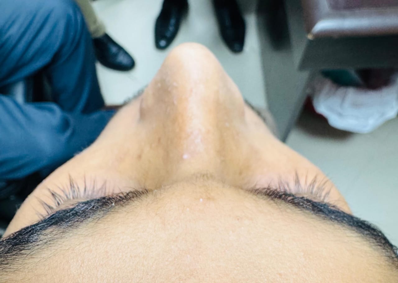 After Aesthetic Rhinoplasty