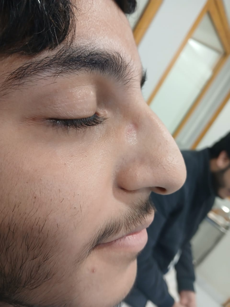 Before Septorhinoplasty