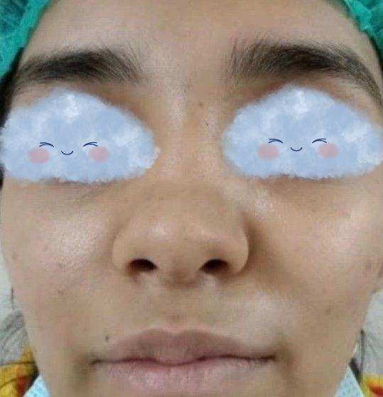 Before Aesthetic Rhinoplasty